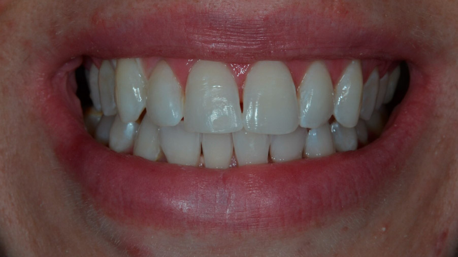 blanqueamiento dental natural