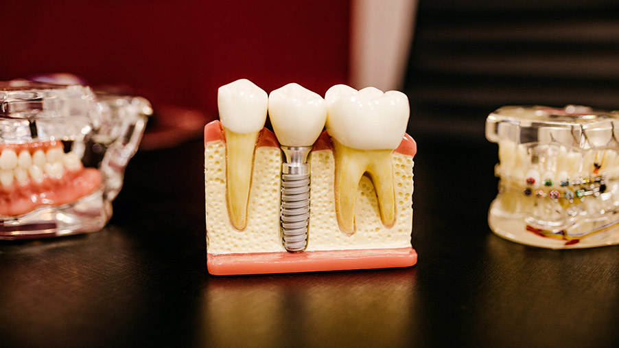 implantes dentales y prótesis
