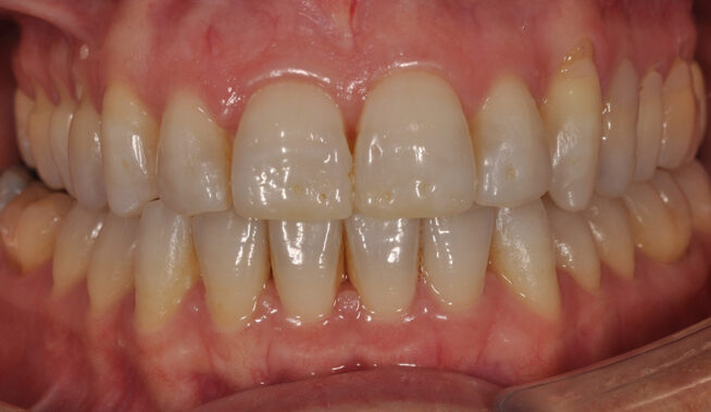 ortodoncia con alineadores