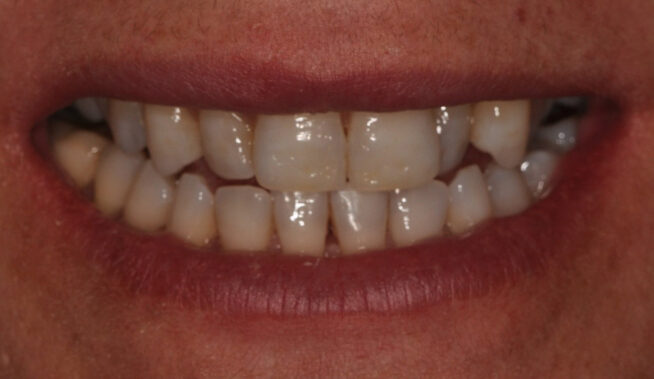 ortodoncia con alineadores