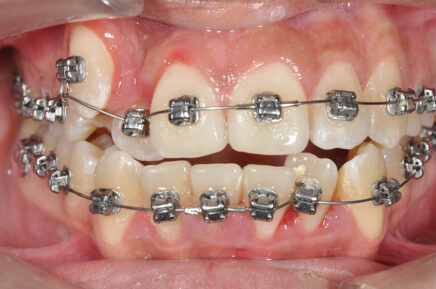 ortodoncia fija sistema damon