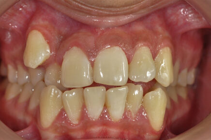 ortodoncia fija sistema damon